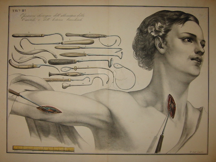 Sandri Antonio Tavola II. Operazione chirurgica dell'allacciatura della grande carotide, e dell'arteria bracchiale 1854 Brescia